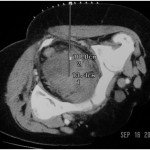 CT-guided_drainage_of_pelvic_abscess_1