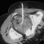 CT-guided_drainage_of_pelvic_abscess_2