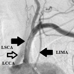 PSxxx7724 LSCAstenosis_afterstenting