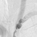 PSxxx7724_LSCAstenosis_beforestenting