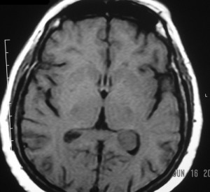 Choroid plexus menigioma T1_text[1]