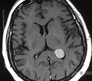 Choroid plexus meningioma T1 postgad_text[1]