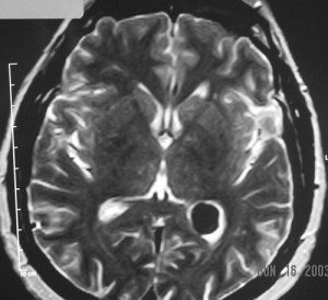 Choroid plexusmenigiomaT2_text[1]