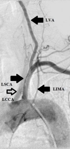 PSxxx7724 LSCAstenosis_afterstenting