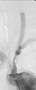 PSxxx7724_LSCAstenosis_beforestenting