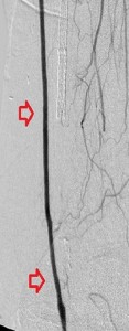 SHxxx4632_mid lfempopbypass_after