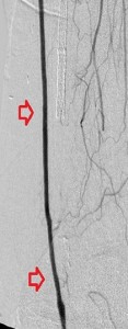 SHxxx4632_mid lfempopbypass_after