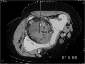 CT-guided_drainage_pelvic abscess_1