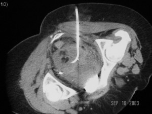 CT-guided_drainage_pelvic abscess_2