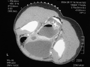 CT-guided_drainage_pelvic abscess_3