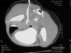 CT-guided_drainage_pelvic abscess_4