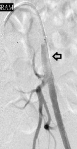 Focal_left common_femoal_stenosis_after stenting