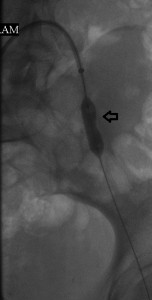Focal_left common_femoal_stenosis_at_stenting