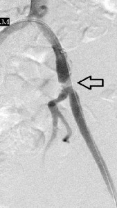 Focal_left_common_femoal_stenosis_before_stenting