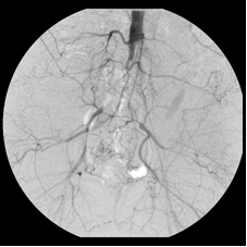 Iliac_arteries1