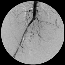 Iliac_arteries2