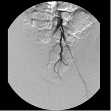 Iliac_arteries3