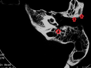 Left temporal_bone_fracture