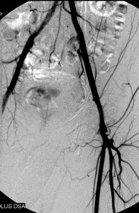 Left_iliac_stenting_post_2