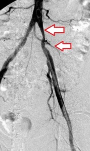 Left_iliac_stenting_pre_1