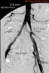 Left_iliac_stenting_pre_2