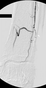 Multifocal_disease_LCFA_LSFA_LPOPA_distal leg_before