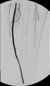 Multifocal_disease_LCFA_LSFA_LPOPA_mid_post