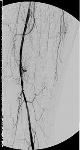 Multifocal_disease_LCFA_LSFA_LPOPA_mid_pre