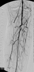 Multifocal_disease_LCFA_LSFA_LPOPA_prox leg_before