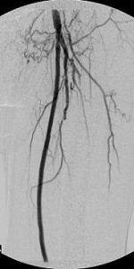 Multifocal_disease_LCFA_LSFA_LPOPA_proximal_post