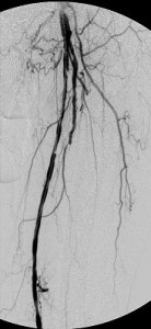 Multifocal_disease_LCFA_LSFA_LPOPA_proximal_pre