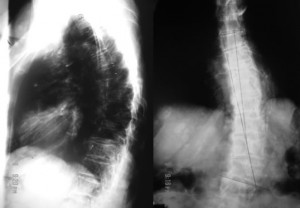 Neurofibromatosis