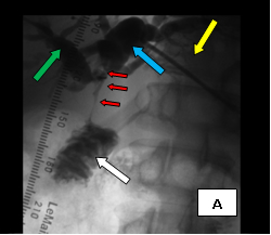 Percut_biliary_decompression_1