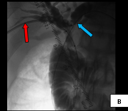 Percut_biliary_decompression_2