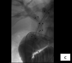 Percut_biliary_decompression_3