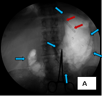 Percut_gastrostomy_1