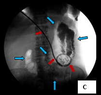 Percut_gastrostomy_3