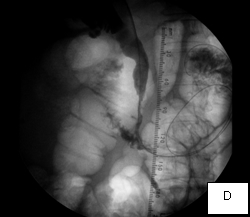 Percutaneous_biliary_decompression_D