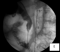 Percutaneous_biliary_decompression_E