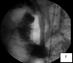 Percutaneous_biliary_decompression_F