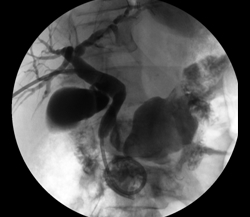 Percutaneous_biliary_decompression_G