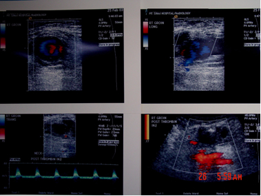 Pseudoaneurysm_pretx and posttx