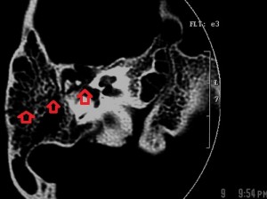 Right_temporal_bone_fracture