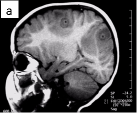 Sagittal_T1_WI_A