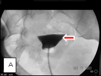 Transcervical_fallopian_tube_recanalization_1