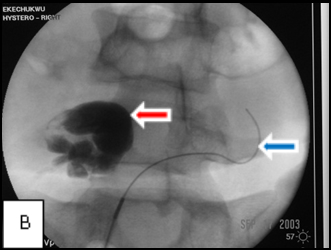 Transcervical_fallopiantube_recanalization_2