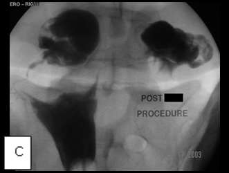 Transcervical_fallopiantube_recanalization_3