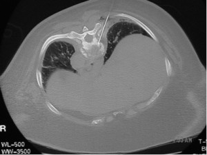 vertebral_metastatic_disease