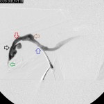 Right brachial venogram during intervention: Dilated 2nd and 3rd stenoses; juxtanastomotic stenosis was treated, but image not shown.