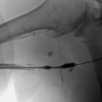 Balloon dilation of critical venous stenosis distal to the AV graft.